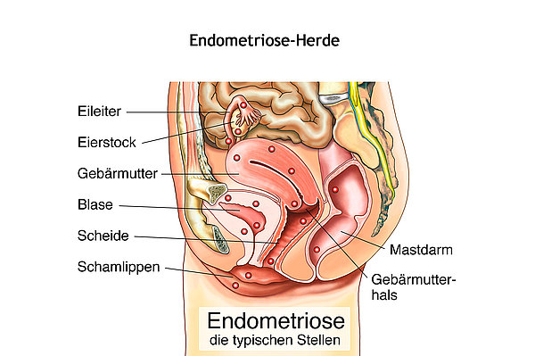 Wie verhält sich Endometriose in der Schwangerschaft?