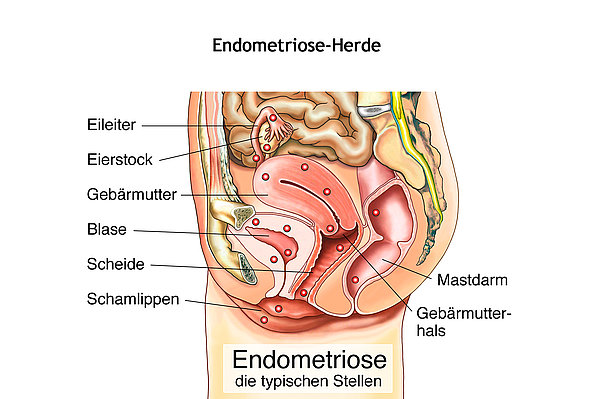 Entzündung beckenboden Chronische Schmerzen